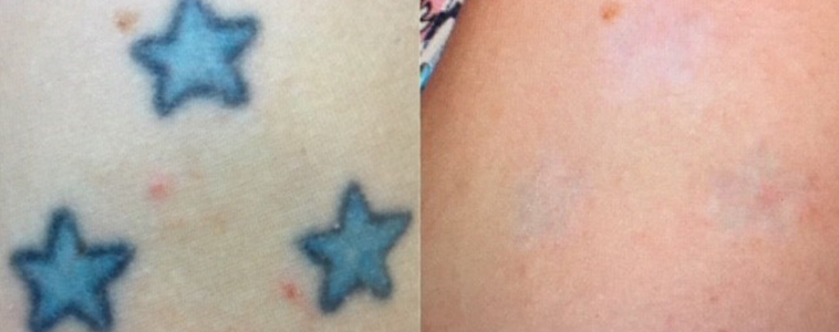 Tattoo Removal Before  After  Charlotte Huntersville NC Saluja Cosmetic  and Laser Center